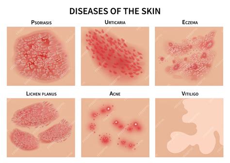 herpes rash vs other skin conditions
